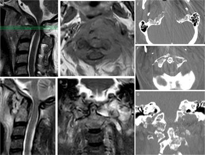 3D-printed guides for cervical pedicle screw placement in primary spine tumor: Case report and technical description